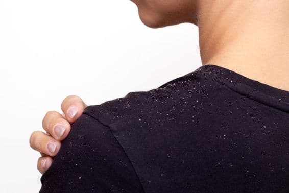 Young woman in a black shirt holding her shoulder, dandruff traces on the shirt.