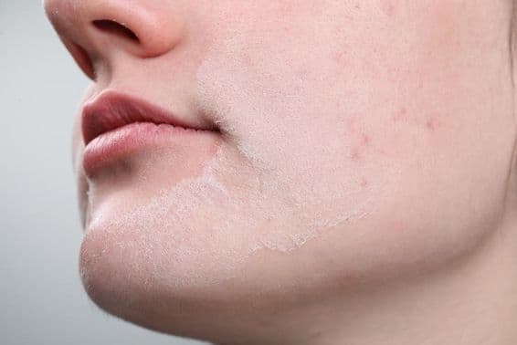 Woman with dry skin on her face against a light background.