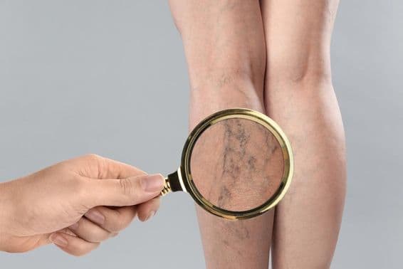 Woman suffering from varicose veins.